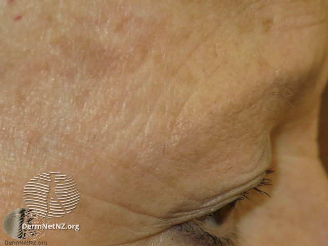 File:Graham Little syndrome. Loss of hair of eyebrows (DermNet NZ hair-nails-sweat-graham-little-2).jpg