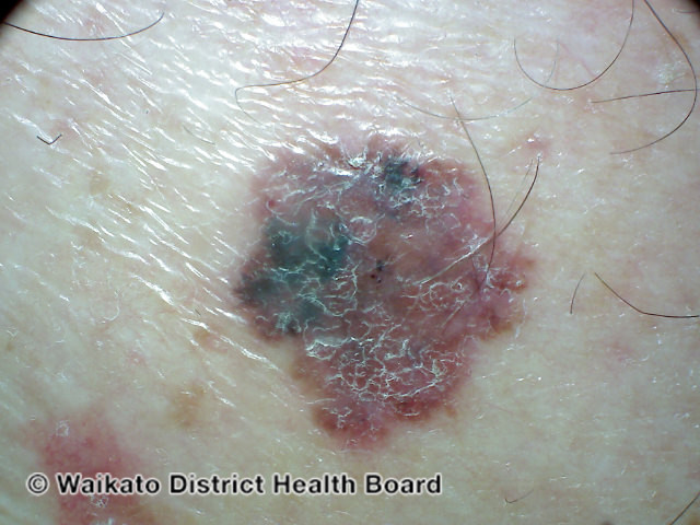 File:Invasive melanoma (DermNet NZ melanoma-abcd-09).jpg