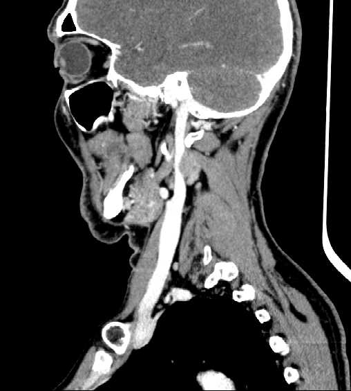 File:Nasopharyngeal carcinoma - infiltrating the clivus (Radiopaedia 62583-70875 C 38).jpg