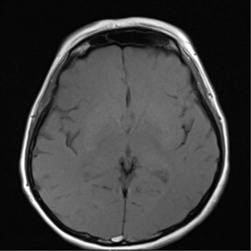 File:Nasopharyngeal carcinoma with cerebral abscess (Radiopaedia 43018-46273 Axial T1 6).png