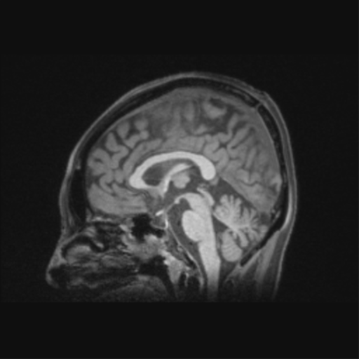 Nasopharyngeal carcinoma with cerebral abscess (Radiopaedia 43018-46274 Coronal T1 fat sat 61).png