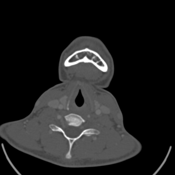File:Nasopharyngeal carcinoma with skull base invasion (Radiopaedia 53415-59705 Axial bone window 152).jpg