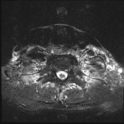 File:Nasopharyngeal carcinoma with skull base invasion (Radiopaedia 59258-66600 Axial T2 fat sat 17).jpg