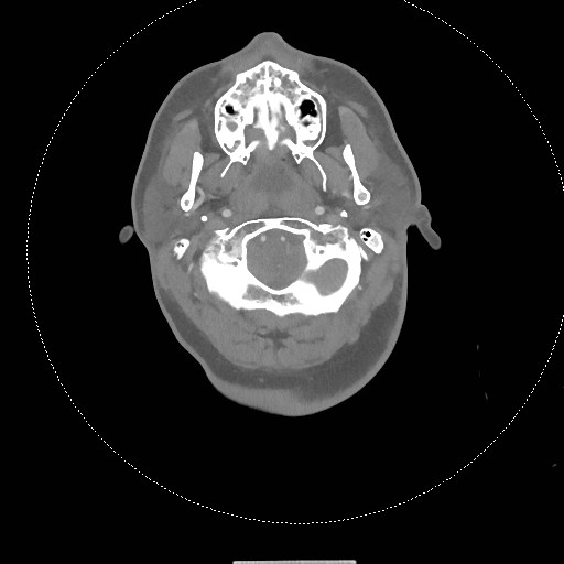 Neck CT angiogram (intraosseous vascular access) (Radiopaedia 55481-61945 B 247).jpg
