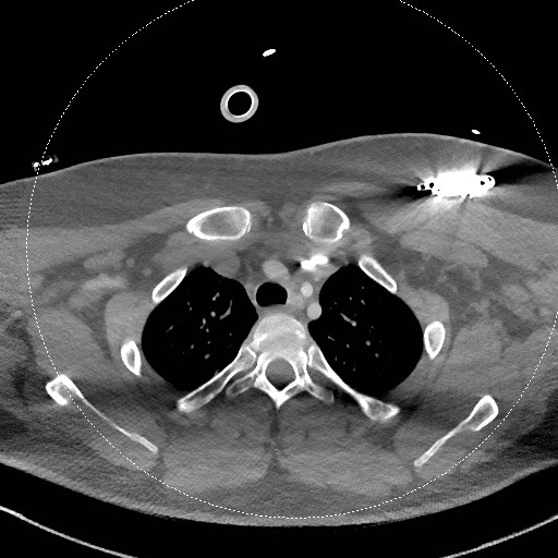 Neck CT angiogram (intraosseous vascular access) (Radiopaedia 55481-61945 B 78).jpg
