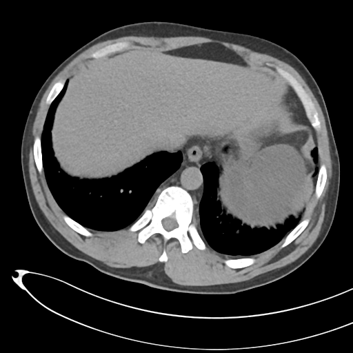 File:Necrotizing pancreatitis with acute necrotic collections (Radiopaedia 38829-41012 Axial non-contrast 13).png