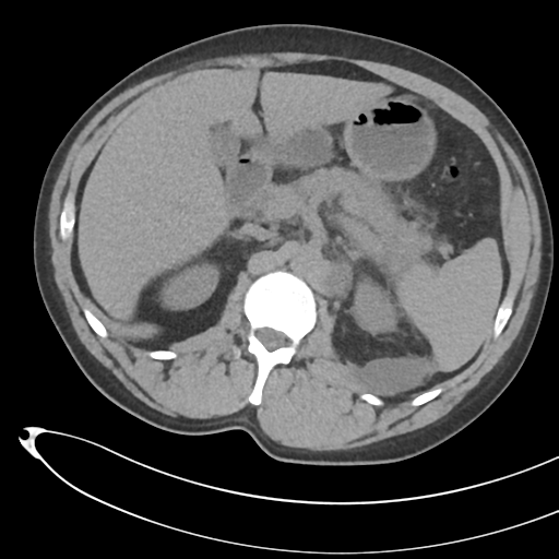 File:Necrotizing pancreatitis with acute necrotic collections (Radiopaedia 38829-41012 Axial non-contrast 28).png