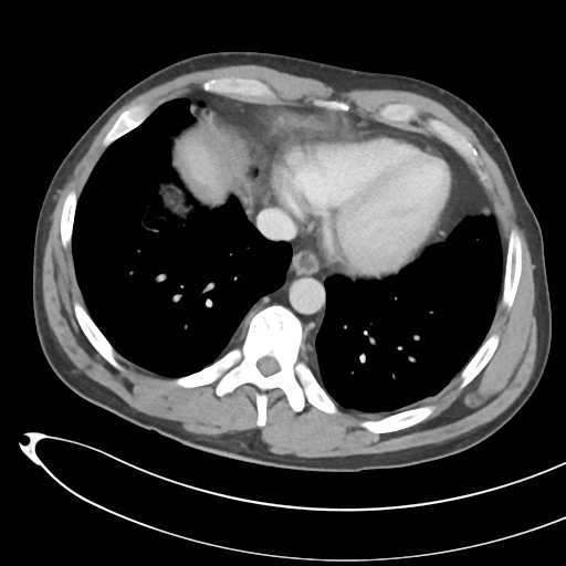 File:Necrotizing pancreatitis with acute necrotic collections (Radiopaedia 38829-41012 B 7).png