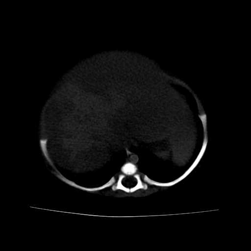 File:Neuroblastoma (Radiopaedia 20876-20799 Axial bone window 5).jpg
