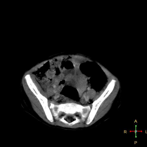 File:Neuroblastoma (Radiopaedia 24751-25016 D 33).jpg