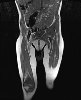 File:Neuroblastoma with bone metastases (Radiopaedia 67080-76414 Coronal T1 6).jpg