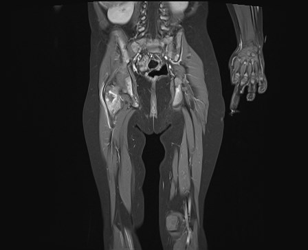 File:Neuroblastoma with bone metastases (Radiopaedia 67080-76414 E 17).jpg