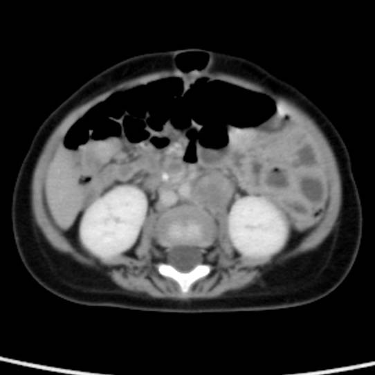 Neuroblastoma with skull metastases (Radiopaedia 30326-30960 C 34).jpg