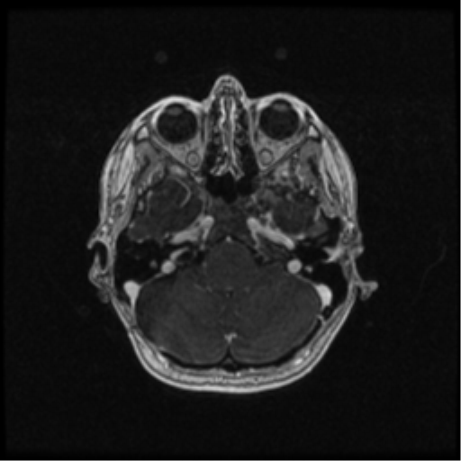 Neurofibromatosis type 2 (Radiopaedia 45229-49244 Axial T1 C+ 37).png