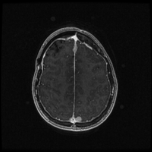 Neurofibromatosis type 2 (Radiopaedia 45229-49244 Axial T1 C+ 88).png