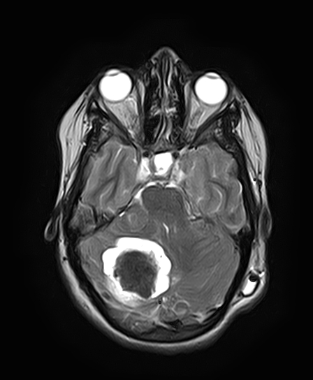 File:Neurofibromatosis type 2 (Radiopaedia 66211-75401 Axial T2 12).jpg