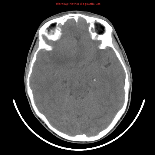 File:Neurofibromatosis type 2 (Radiopaedia 8953-9732 Axial non-contrast 15).jpg