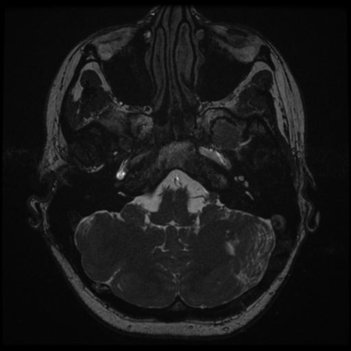 Neurofibromatosis type 2 - bilateral acoustic neuromata (Radiopaedia 40060-42566 Axial FIESTA 24).png
