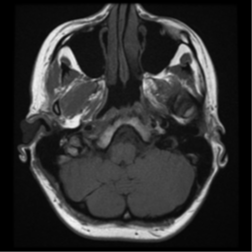File:Neurofibromatosis type 2 - bilateral acoustic neuromata (Radiopaedia 40060-42566 Axial T1 4).png