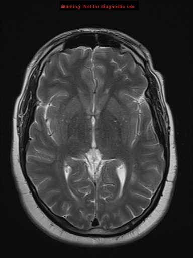 File:Neuroglial cyst (Radiopaedia 10713-11184 Axial T2 12).jpg