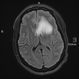 File:Neurotoxoplasmosis - concentric target sign (Radiopaedia 70644-80784 Axial FLAIR 12).jpg