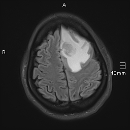 File:Neurotoxoplasmosis - concentric target sign (Radiopaedia 70644-80784 Axial FLAIR 17).jpg