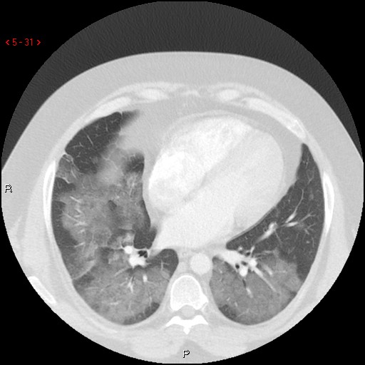File:Non-specific interstitial pneumonitis (Radiopaedia 27044-27222 Axial lung window 22).jpg