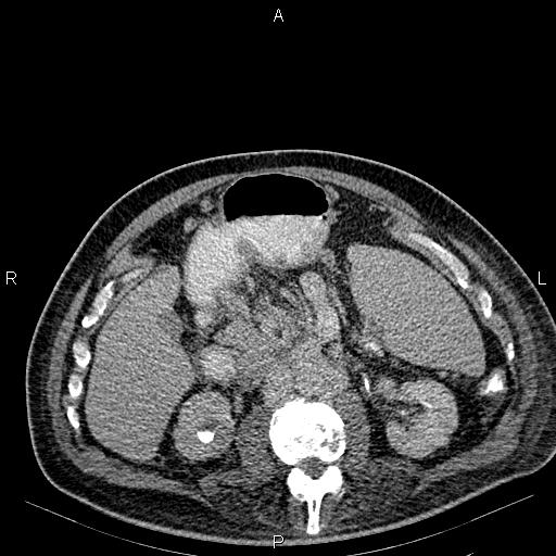 Non Hodgkin lymphoma in a patient with ankylosing spondylitis (Radiopaedia 84323-99621 Axial C+ delayed 32).jpg