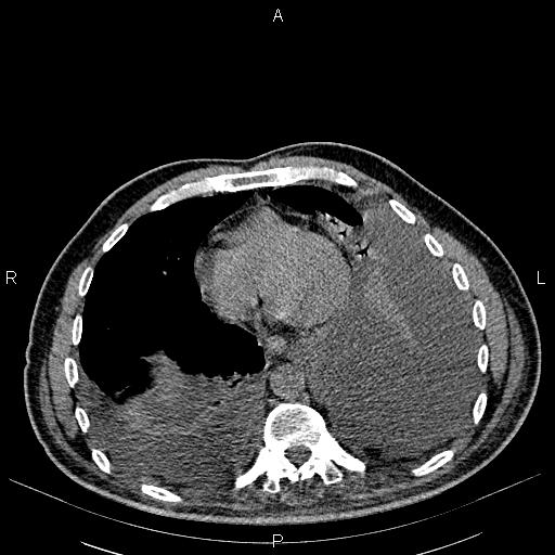 File:Non Hodgkin lymphoma in a patient with ankylosing spondylitis (Radiopaedia 84323-99621 Axial non-contrast 21).jpg