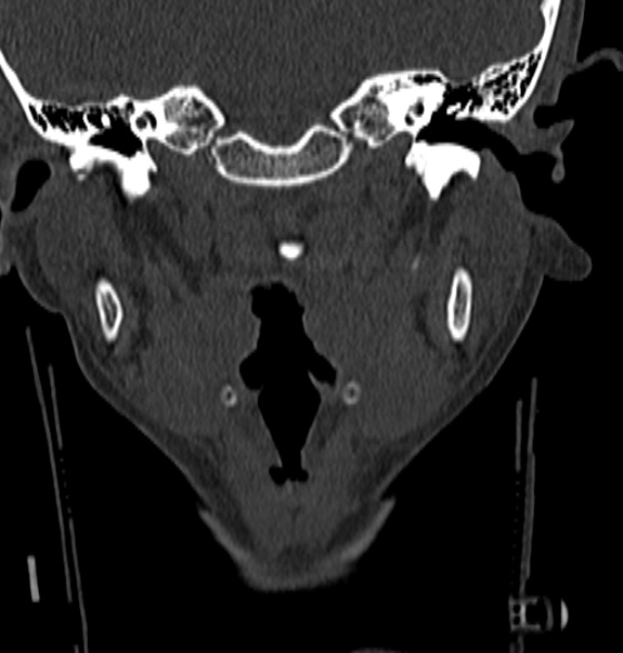 File:Normal CT cervical spine - 12-year-old (Radiopaedia 55352-61775 Coronal bone window 16).jpg