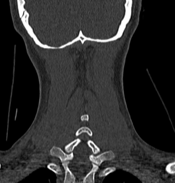 File:Normal CT cervical spine - 12-year-old (Radiopaedia 55352-61775 Coronal bone window 188).jpg