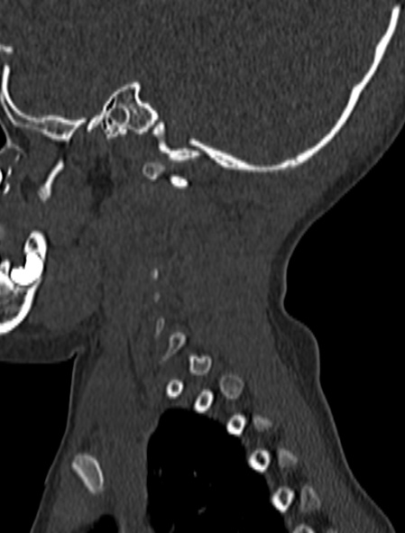 Normal CT cervical spine - pediatric (Radiopaedia 52549-58462 Sagittal bone window 16).jpg