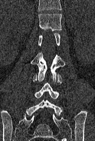 Normal CT lumbar spine (Radiopaedia 53981-60118 Coronal bone window 43).jpg