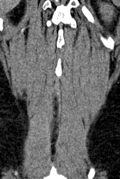 Normal CT lumbar spine (Radiopaedia 53981-60118 F 92).jpg