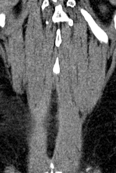 Normal CT lumbar spine (Radiopaedia 53981-60118 F 94).jpg