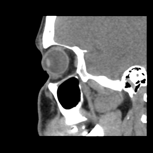Normal CT paranasal sinuses (Radiopaedia 42286-45390 F 45).jpg