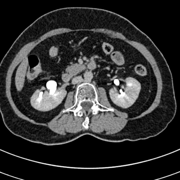 File:Normal CT split bolus study of the renal tract (Radiopaedia 48631-53634 Axial split bolus 90).jpg
