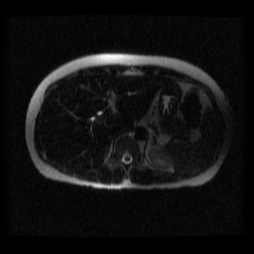 File:Normal MRCP (Radiopaedia 41966-44978 Axial T2 thins 26).png