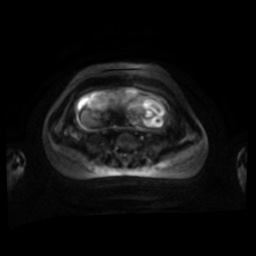 Normal MRI abdomen in pregnancy (Radiopaedia 88001-104541 Axial DWI 60).jpg