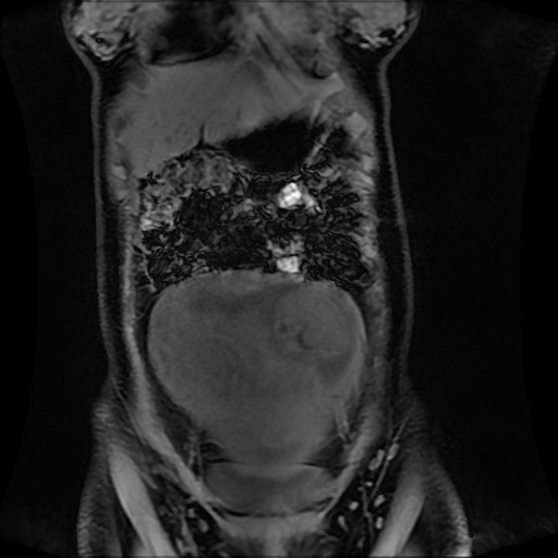 Normal MRI abdomen in pregnancy (Radiopaedia 88001-104541 M 40).jpg