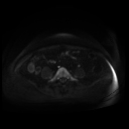 Normal MRI abdomen in pregnancy (Radiopaedia 88005-104548 Axial DWI 105).jpg