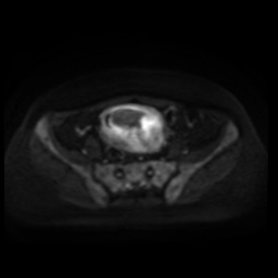Normal MRI abdomen in pregnancy (Radiopaedia 88005-104548 Axial DWI 62).jpg