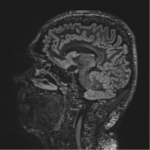 Normal brain MRI (non-focal epilepsy protocol) (Radiopaedia 53917-60040 Sagittal DIR 37).png