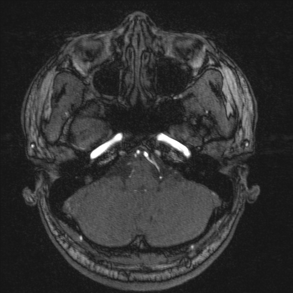 Normal brain MRI including MRA (Radiopaedia 48748-53763 Axial MRA 35).jpg