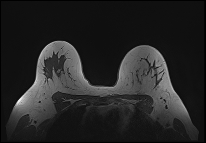 File:Normal breast MRI - dense breasts (Radiopaedia 80454-93850 Axial T1 159).jpg