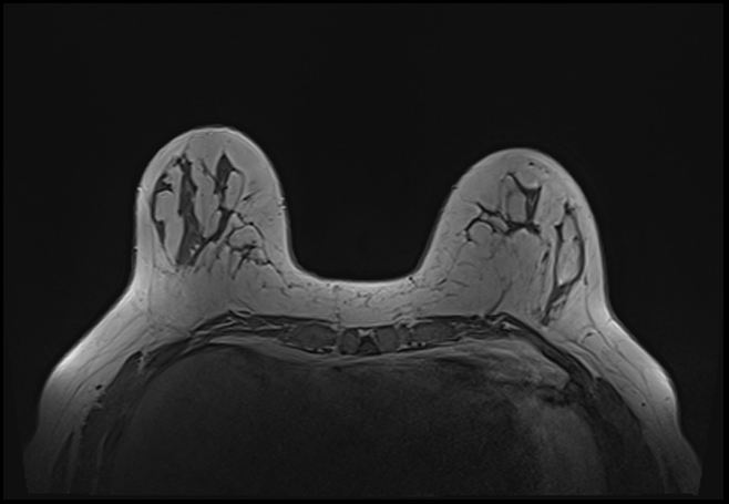File:Normal breast MRI - dense breasts (Radiopaedia 80454-93850 Axial T1 64).jpg