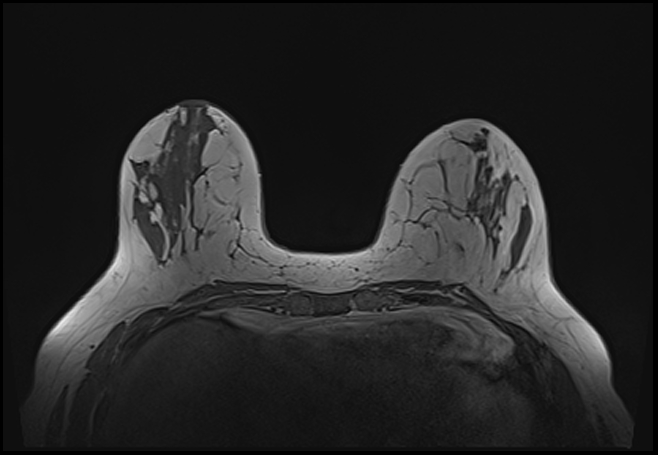 File:Normal breast MRI - dense breasts (Radiopaedia 80454-93850 Axial T1 74).jpg