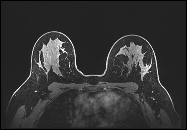 Normal breast MRI - dense breasts (Radiopaedia 80454-93850 C 141).jpg
