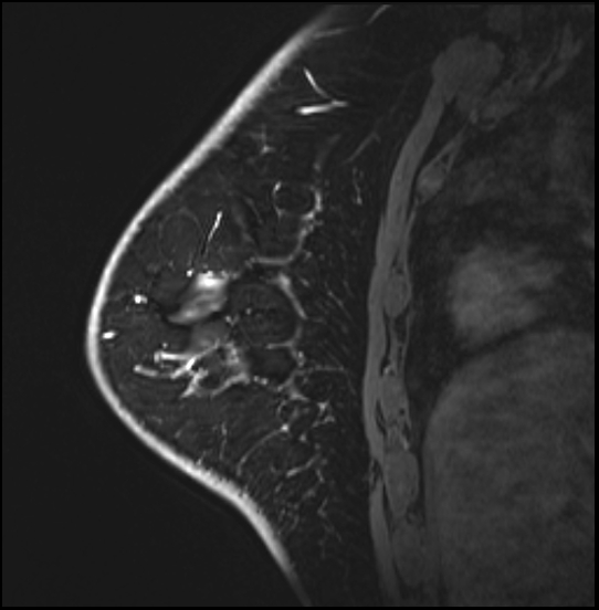 Normal breast MRI - dense breasts (Radiopaedia 80454-93850 I 139).jpg