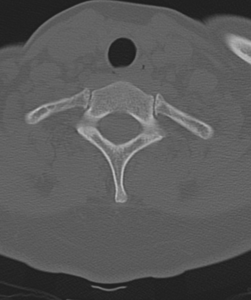Normal cervical spine MRI (including Dixon) (Radiopaedia 42762-45926 Axial bone window 49).png